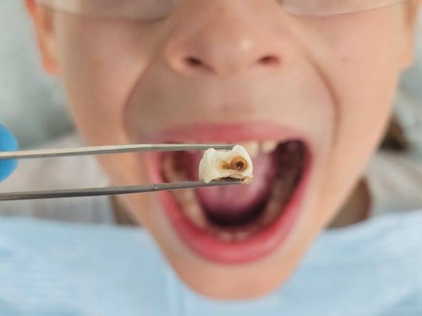 Best Emergency Tooth Extraction in Blue Bell, PA